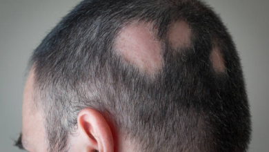 Treatment for Alopecia Areata